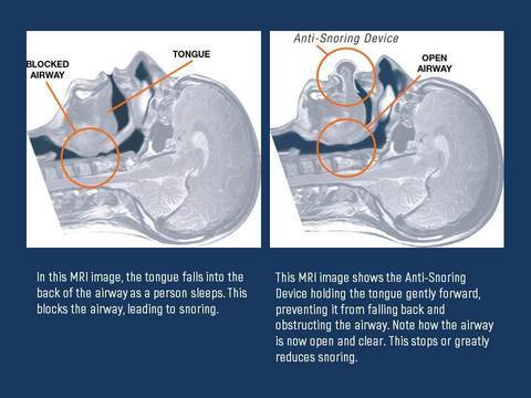 Apnea Tongue Stabiliserend Apparaat
