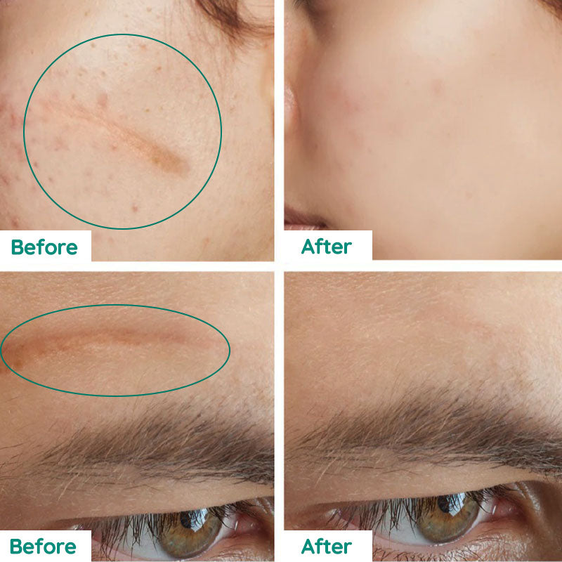 Scar Repair Hudtoner
