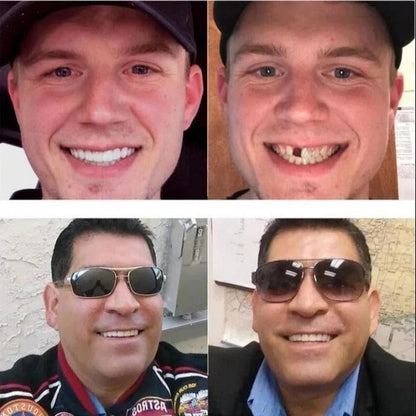 Verstelbare cosmetische glimlach veneers, boven- en onderset