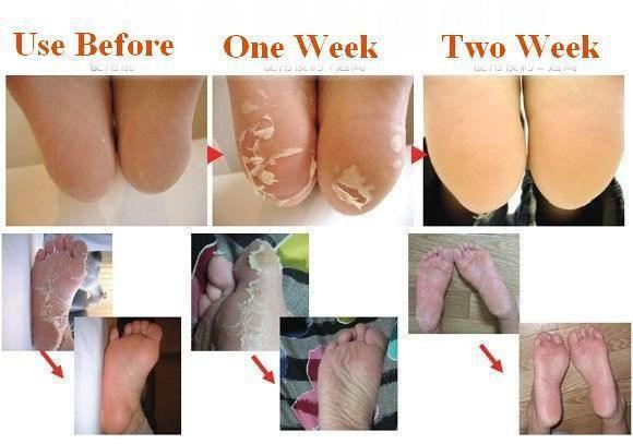 Babies Feet Originele Diepe Hydraterende Exfoliatie voor Voeten Peel Sokken (1 Paar Set)