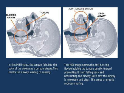Apnea Tongue Stabiliserend Apparaat